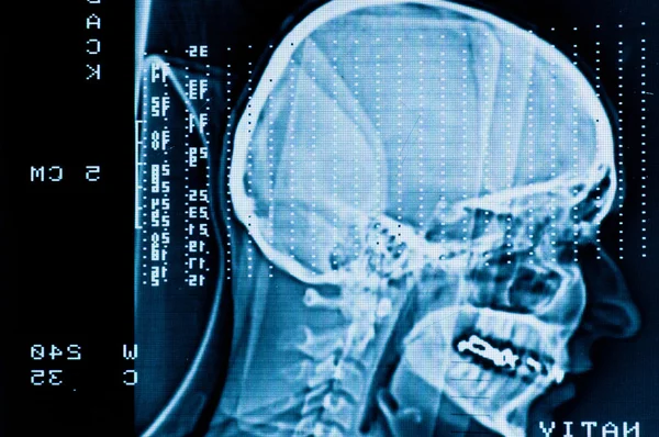 Primo piano di una TAC con cervello e cranio sopra — Foto Stock