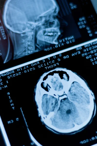 Nahaufnahme eines CT-Scans mit Gehirn und Schädel — Stockfoto