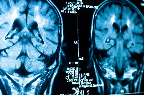 Närbild av en datortomografi med hjärnan — Stockfoto