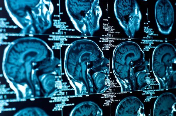 Close-up van een ct-scan met hersenen — Stockfoto