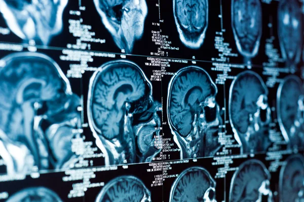 Nahaufnahme eines CT-Scans mit Gehirn und Schädel — Stockfoto