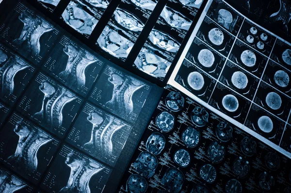 Plusieurs images de tomodensitométrie CT du cou et du cerveau — Photo