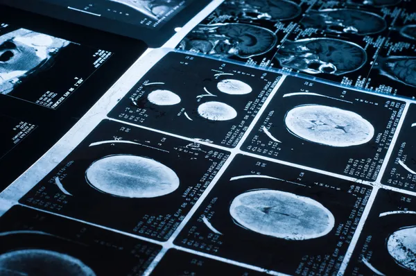 Várias imagens de tomografia computadorizada TC do cérebro — Fotografia de Stock