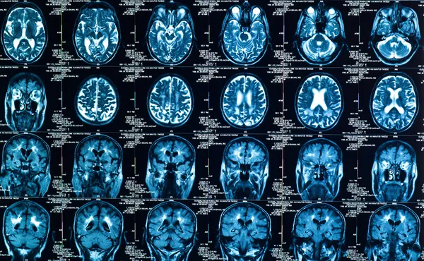 Острая текстура человеческого мозга в КТ — стоковое фото