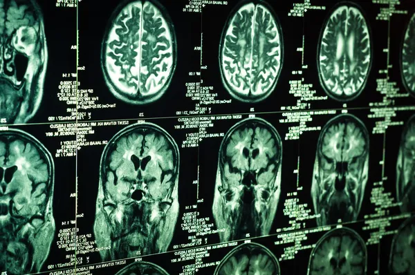 Bardzo ostre skanowania ludzkiego mózgu w zielonej — Zdjęcie stockowe