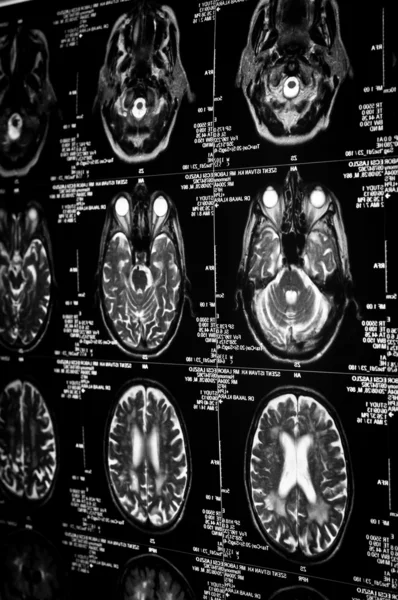 Πολύ αιχμηρή εικόνα ενός αξονική τομογραφία του ανθρώπινου εγκεφάλου — Φωτογραφία Αρχείου