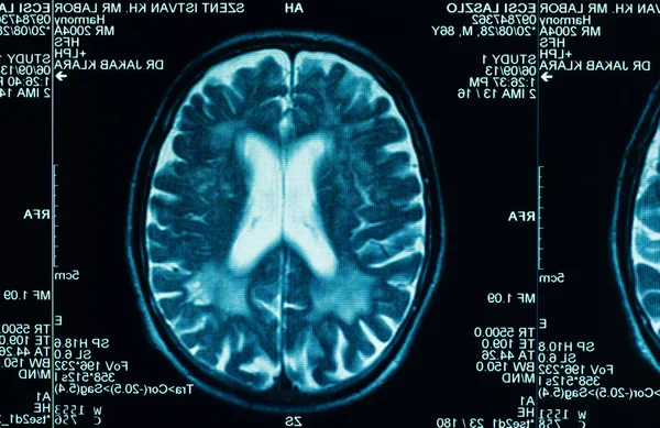 Різке сканування мозку людини — стокове фото