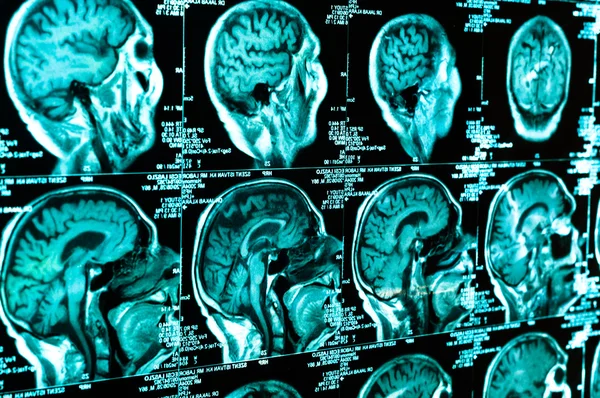 Tomografía computarizada del cerebro humano — Foto de Stock