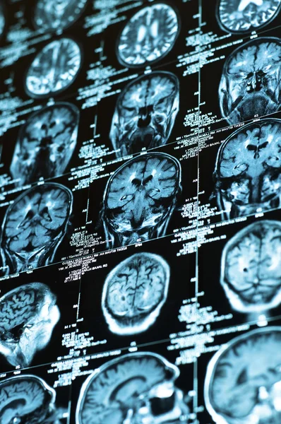Ct сканування плитки людського мозку — стокове фото
