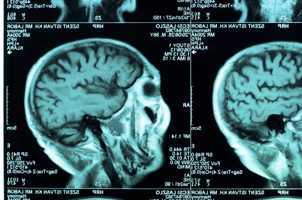 Ct scan of the human brain tile — Stock Photo, Image
