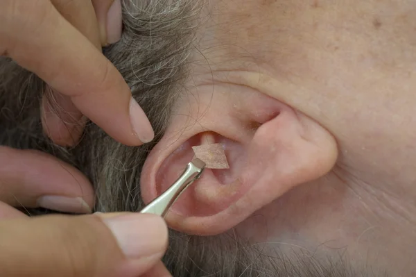 Tratamiento de semillas auriculares — Foto de Stock
