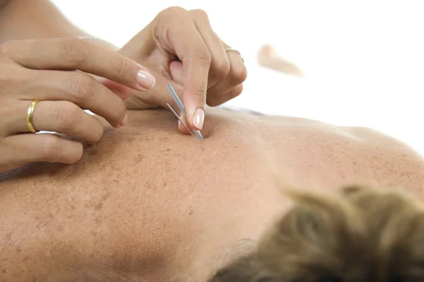 Acupuncture Needles in backs — Stock Photo, Image