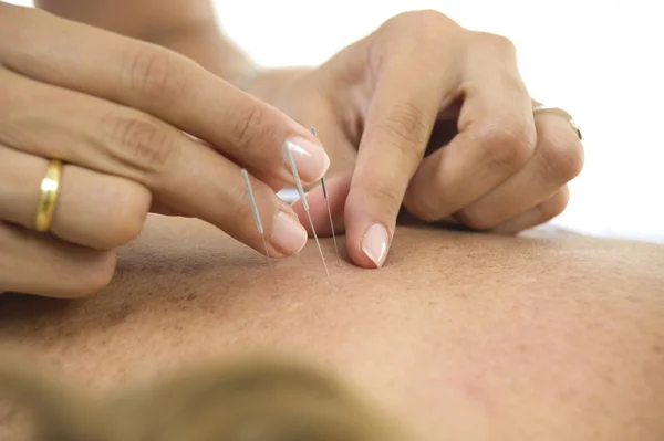 Agujas de acupuntura en la espalda —  Fotos de Stock