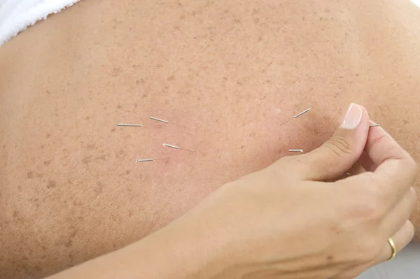 stock image Acupuncture Needles in backs