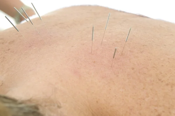 Aiguilles d'acupuncture dans le dos — Photo