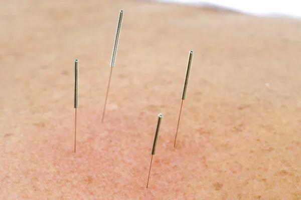 stock image Acupuncture Needles in backs