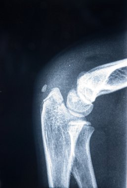 Broken elbow Xray clipart