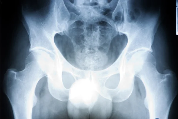 Radiografía de cadera — Foto de Stock