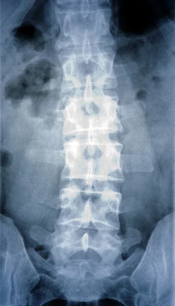 Bent spine — Stock Photo, Image