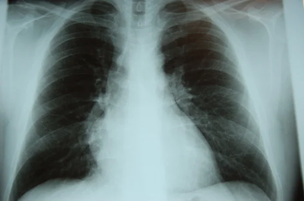 Рентген легенів — стокове фото