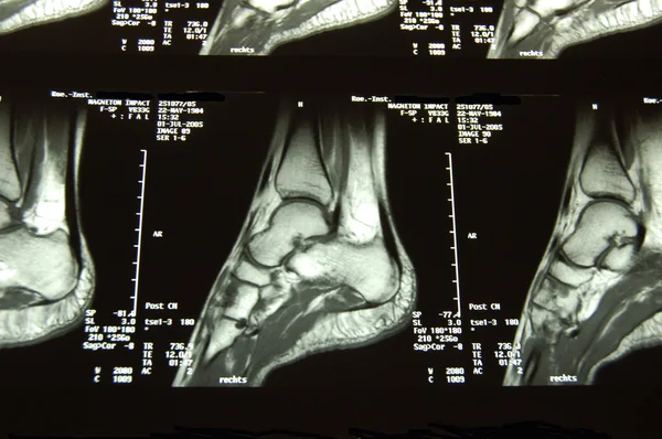 CT bir ayak — Stok fotoğraf