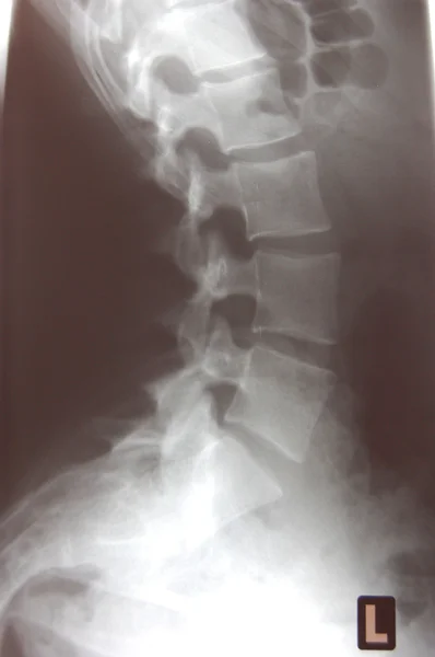 X-ray of an spine — Stock Photo, Image