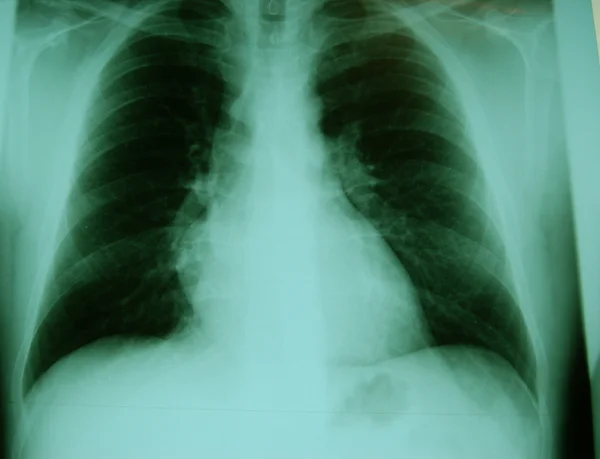 Røntgen af lungerne - Stock-foto