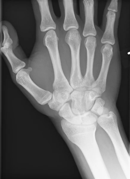Rayos X de una mano — Foto de Stock