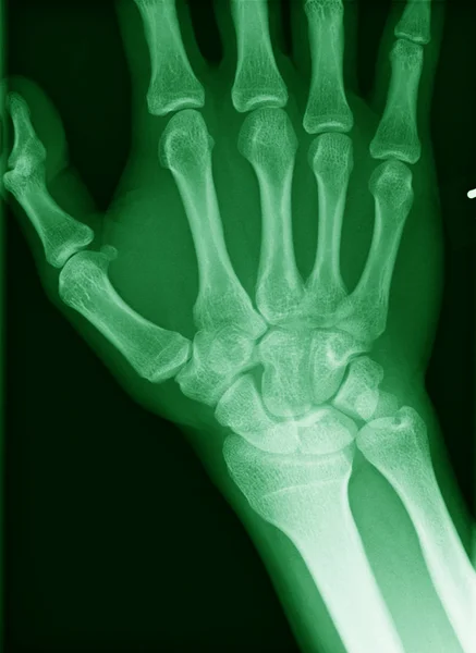 Röntgenbild av en hand — Stockfoto