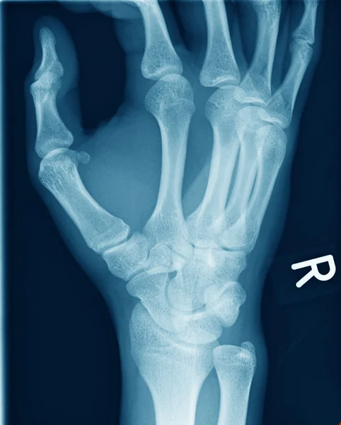 X-ışını bir el — Stok fotoğraf