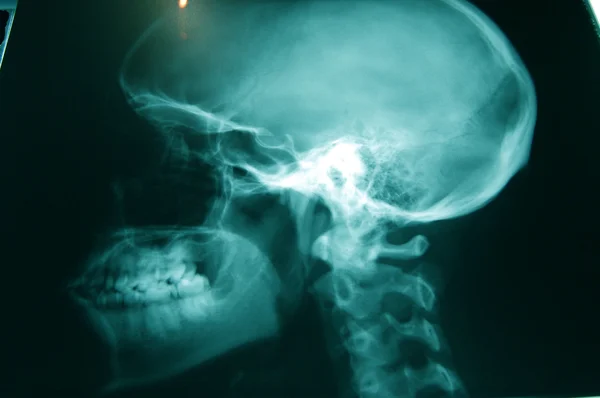 Rayos X de un cráneo — Foto de Stock