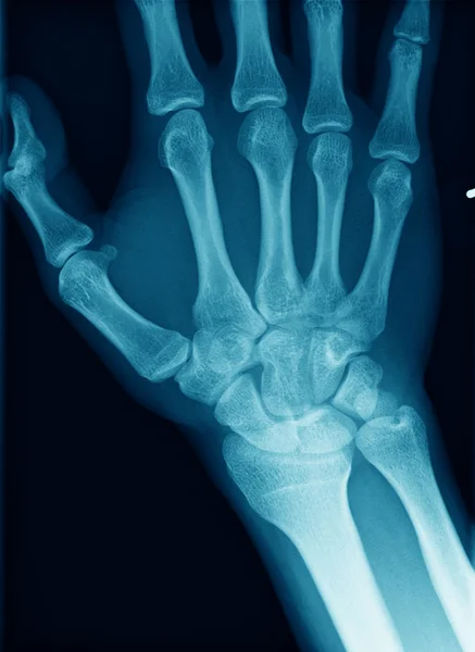 Рентгенівський знімок руки — стокове фото