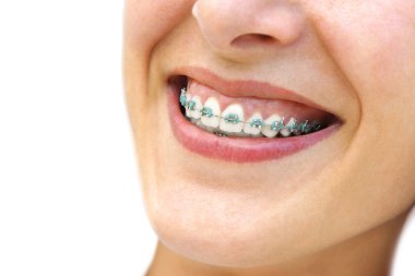 Teeth Braces clipart