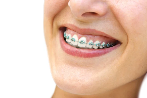Teeth Braces — Stock Photo, Image