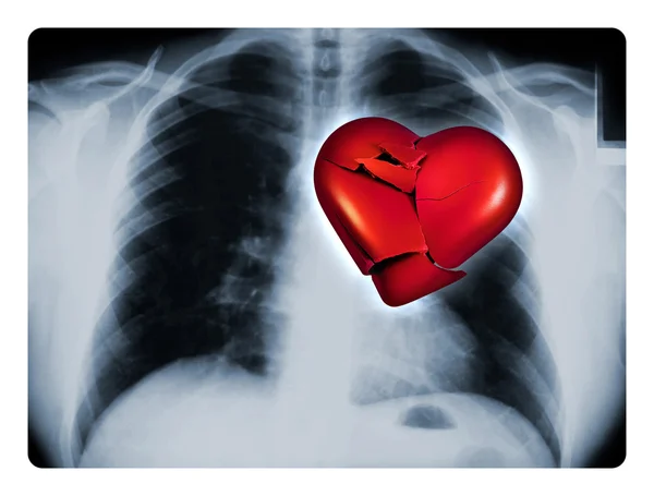 Röntgenbild gebrochenen Herzens — Stockfoto