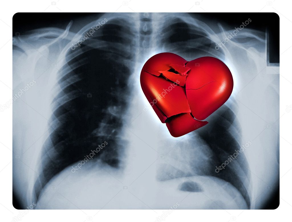 X-Ray Broken Heart