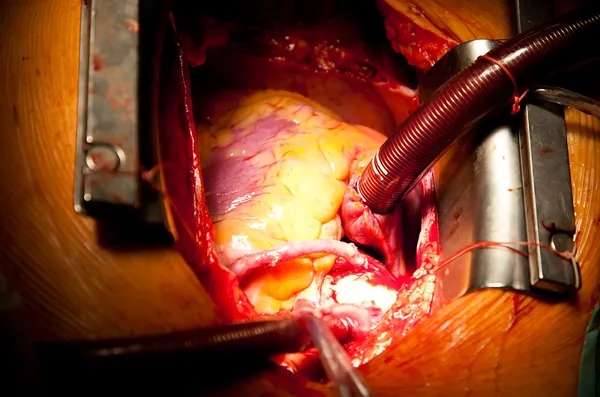 Шунтирование коронарной артерии — стоковое фото