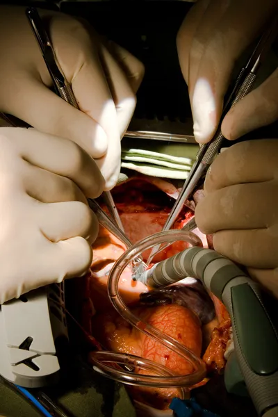 Coronary artery bypass grafting — Stock Photo, Image