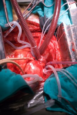 Open heart surgery clipart