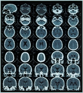 Magnetic resonance scan of brain clipart