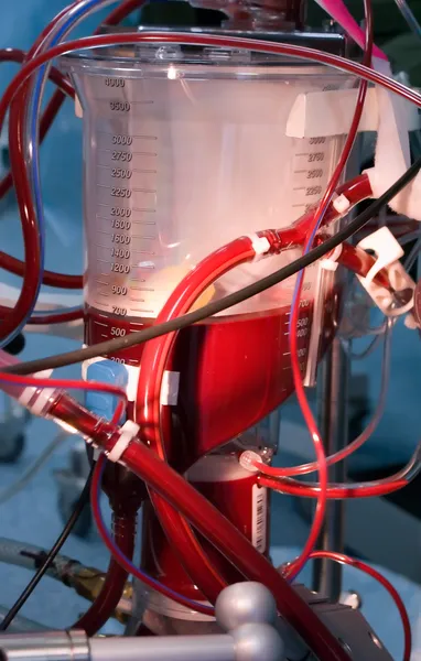 Резервуар крови для кардиолегочного шунтирования — стоковое фото