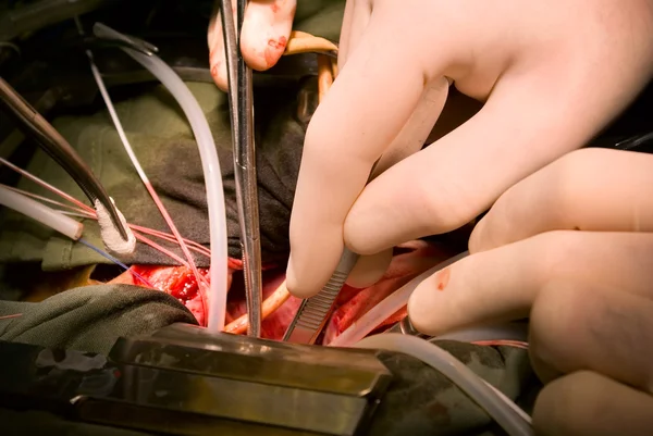 Имплантация протезного клапана сердца — стоковое фото