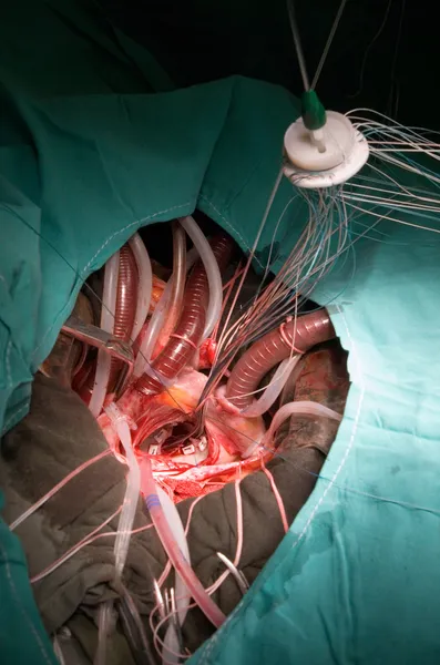 Protetické srdce ventil implantace — Stock fotografie