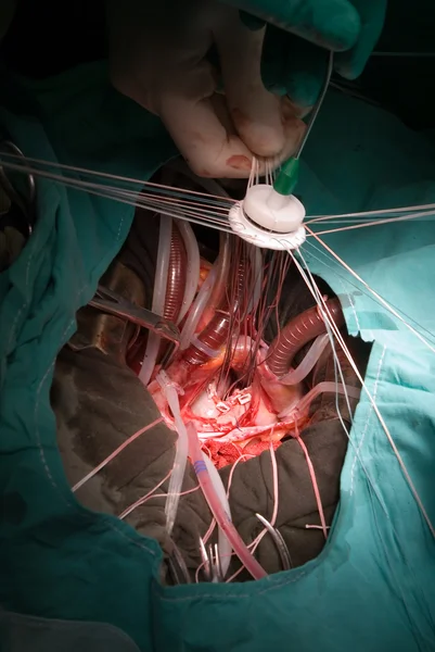 Implantation prothétique de valvule cardiaque — Photo