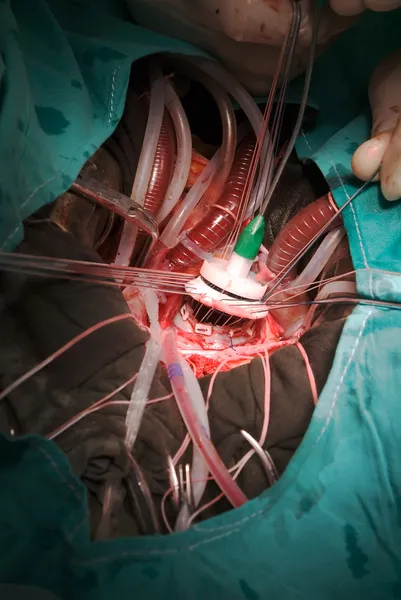 Prosthetic heart valve implantation — Stock Photo, Image