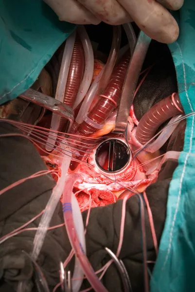 Implante protético de válvula cardíaca — Fotografia de Stock
