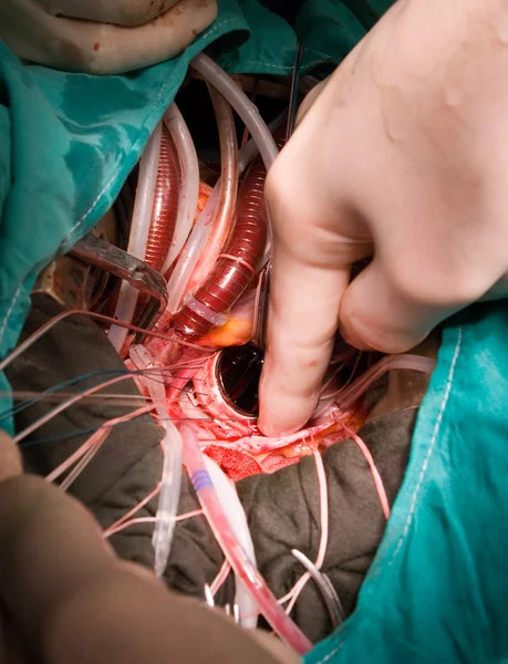 Имплантация протезного клапана сердца — стоковое фото