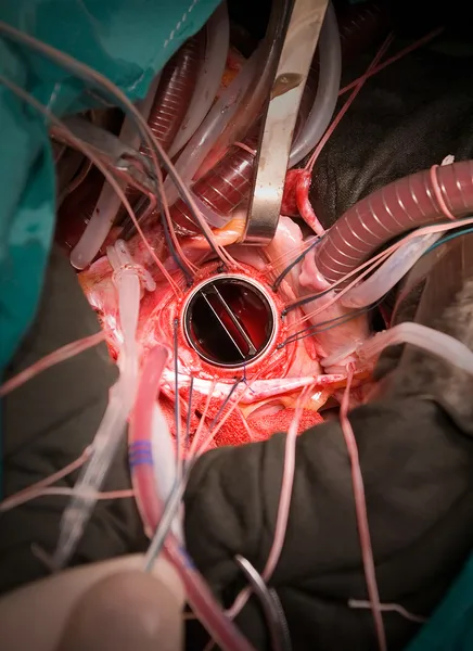 人工心脏瓣膜植入术 — 图库照片
