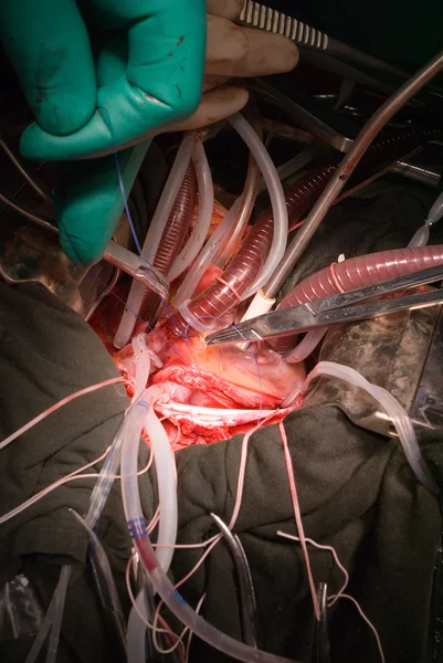 Implantation prothetischer Herzklappen — Stockfoto