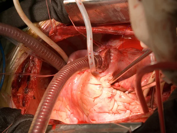 Implantation prothetischer Herzklappen — Stockfoto